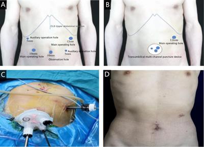 Comparison of clinical safety and feasibility between reduced-port laparoscopic radical gastrectomy and conventional laparoscopic radical gastrectomy: A retrospective study